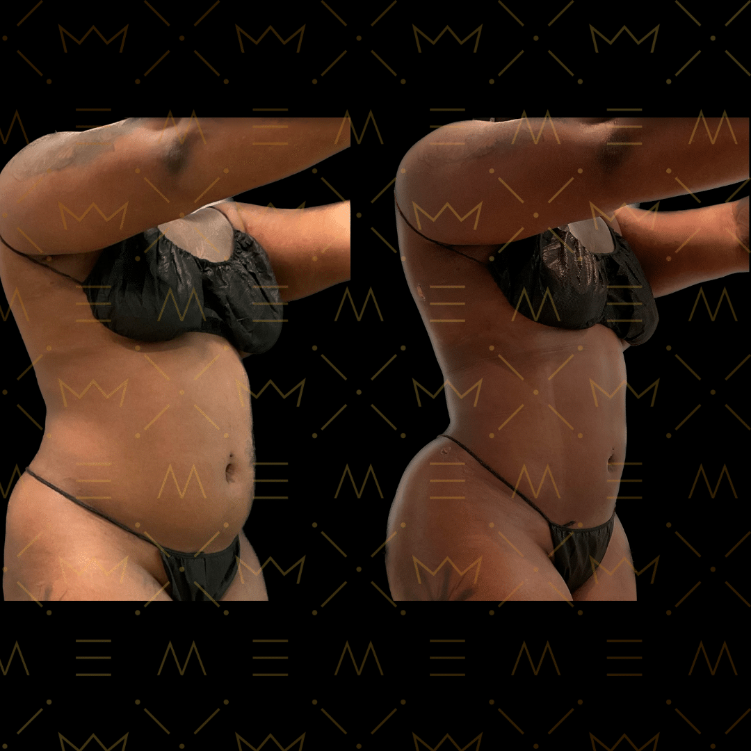 Before and After Image: Ajibody 360 Liposuction and Ab Etching - front