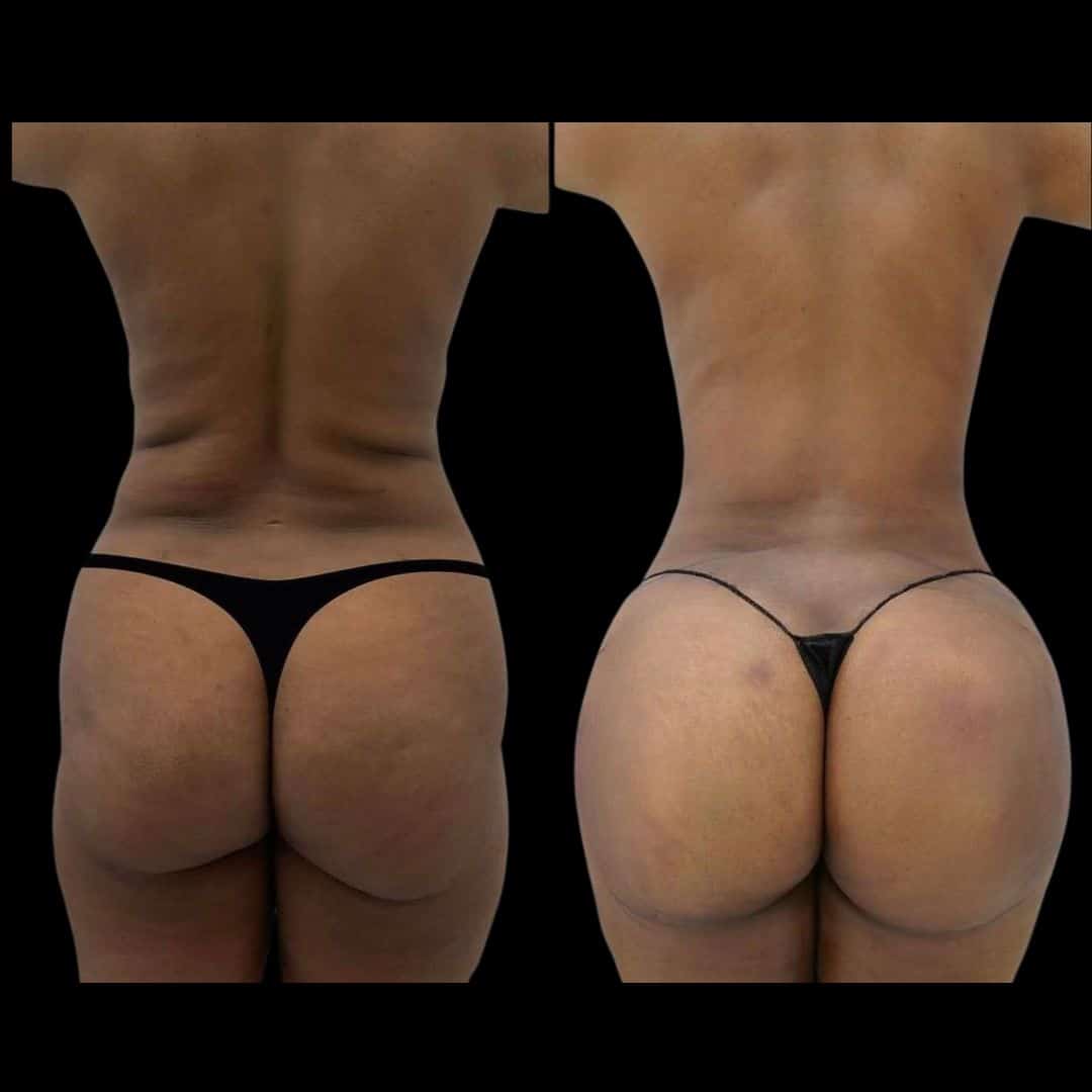 Before and After Image: 360 Lipo, Renuvion, Ajibooty BBL - back