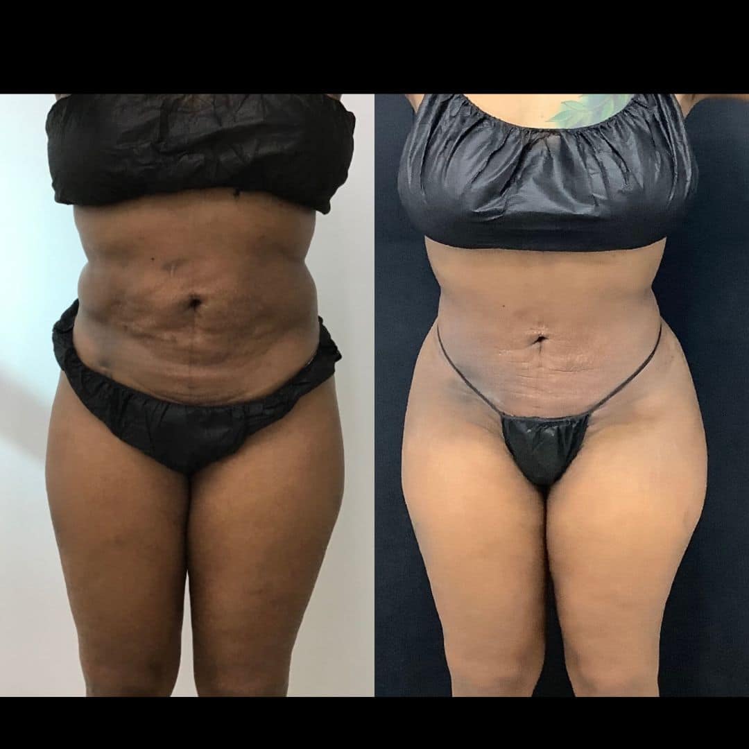 Before and After Image: Ajibody 360 Liposuction with Renuvion - front