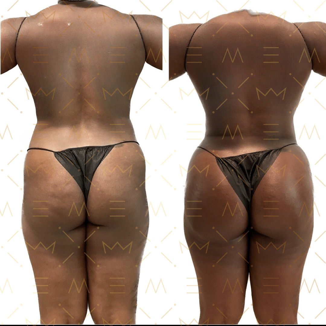 Before and After Image: Ajibooty Fat Transfer to Buttocks - back