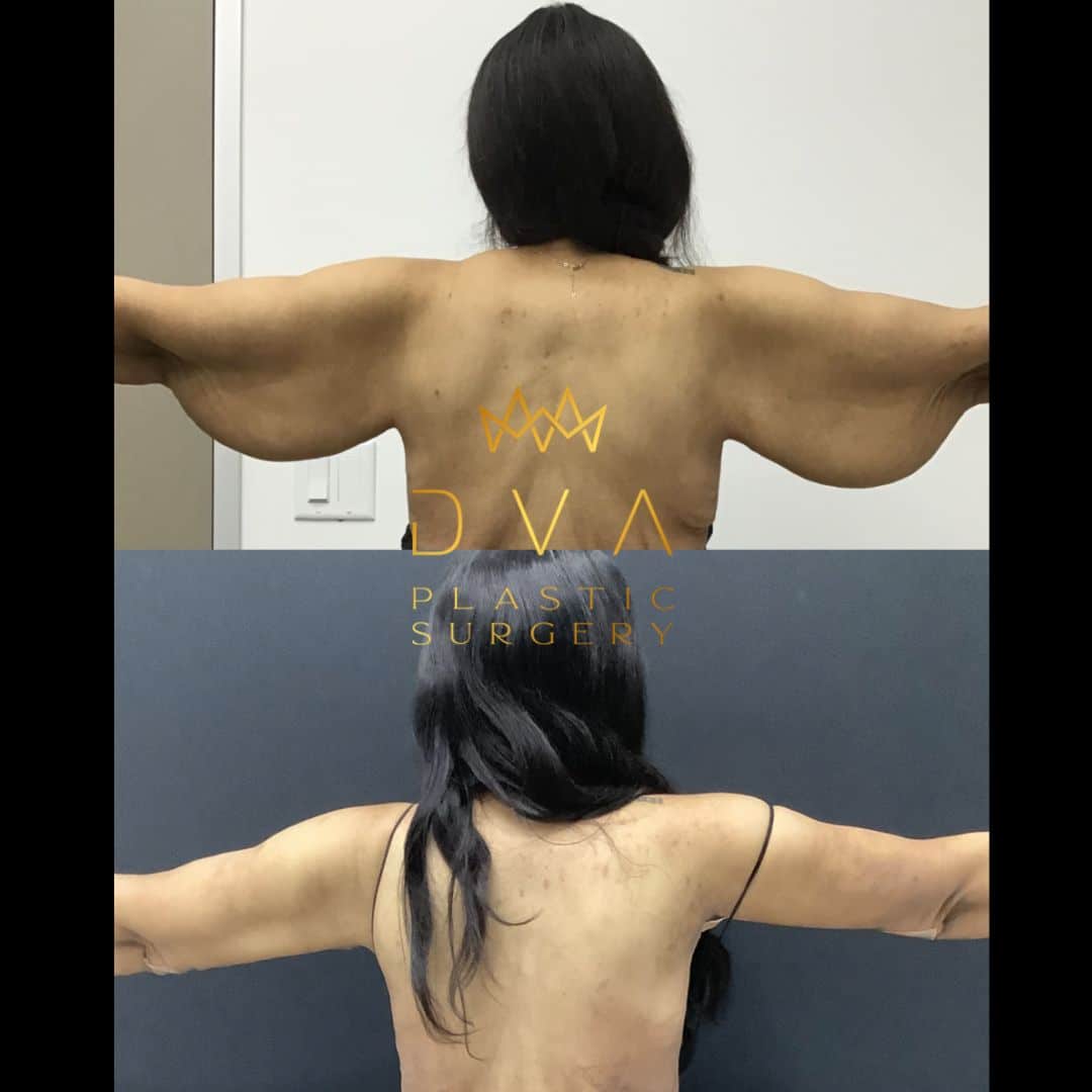 Before and After Image: Brachioplasty - back