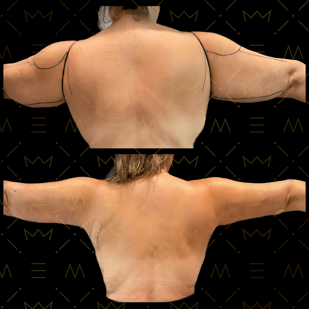 Before and After Image: Brachioplasty