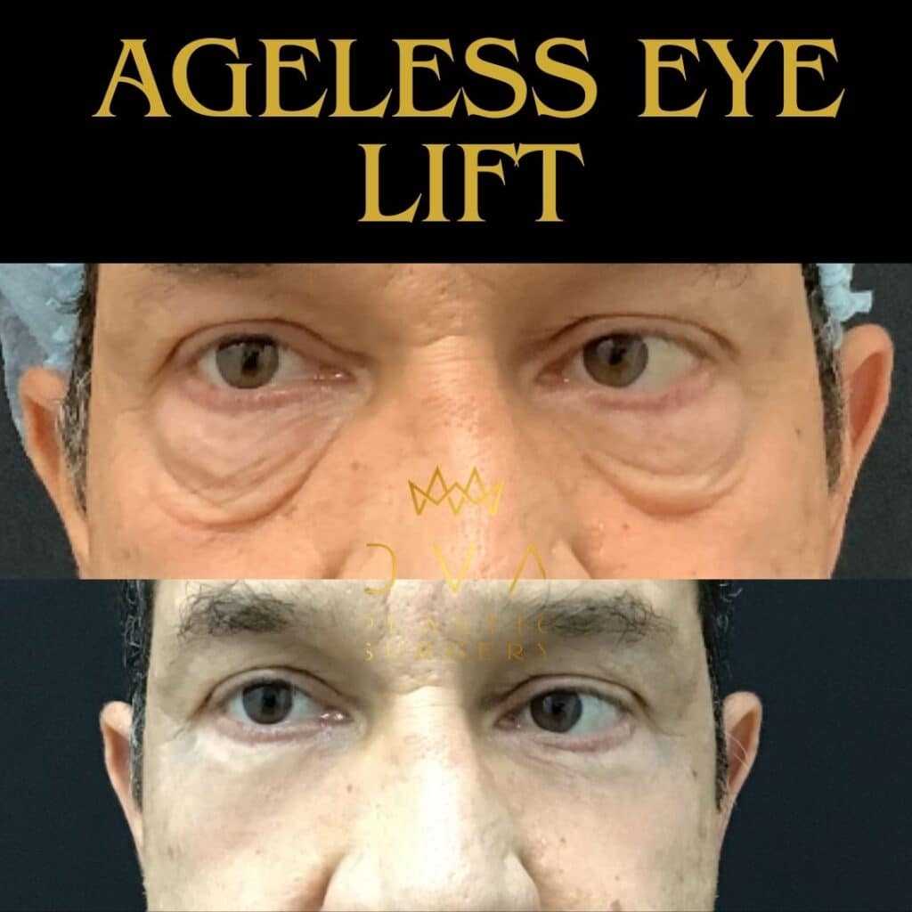 112669 Ageless Eye Lift Lower bleph