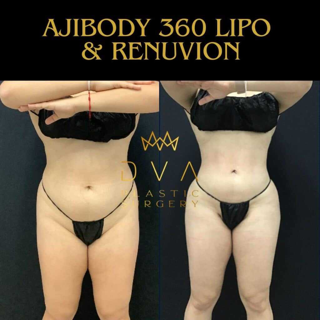 112669 Ajibody 360 Lipo & Renuvion