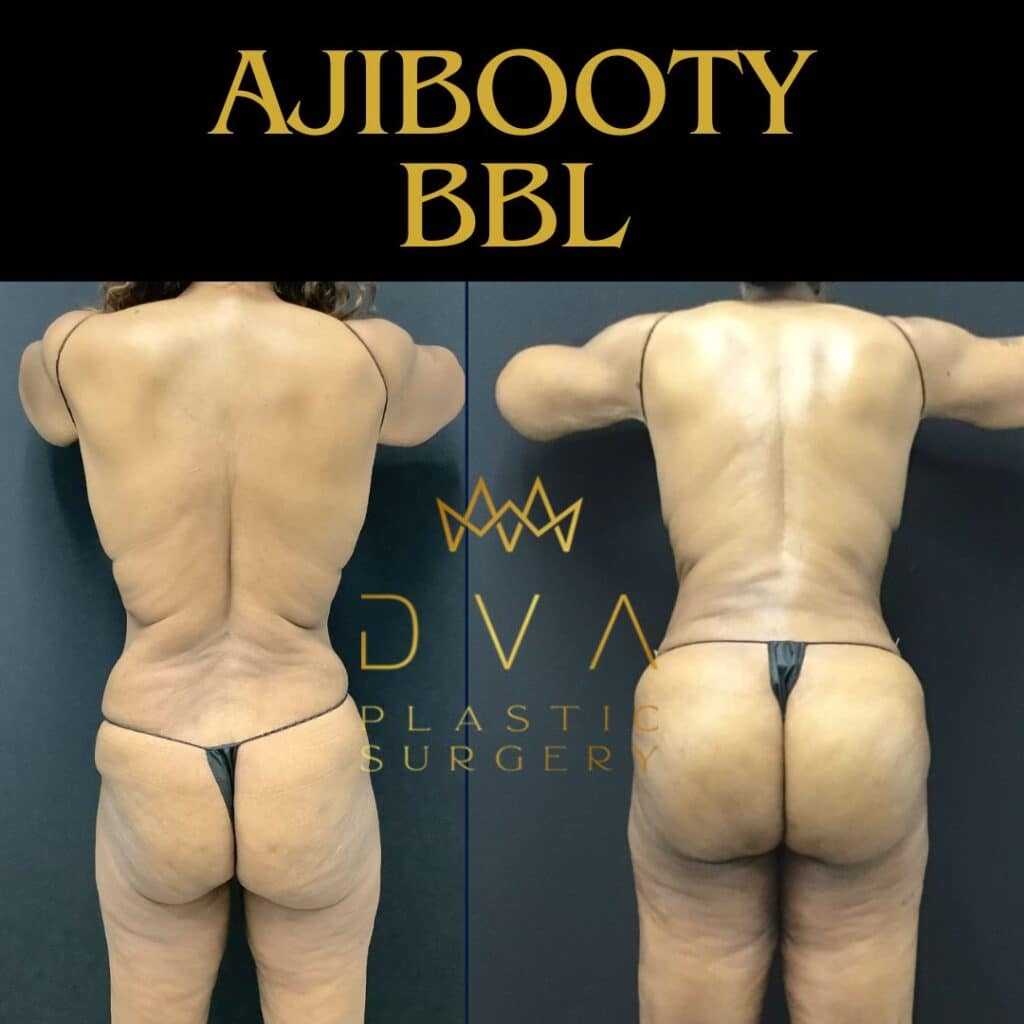 112669 Back Lipo w BBL (5)