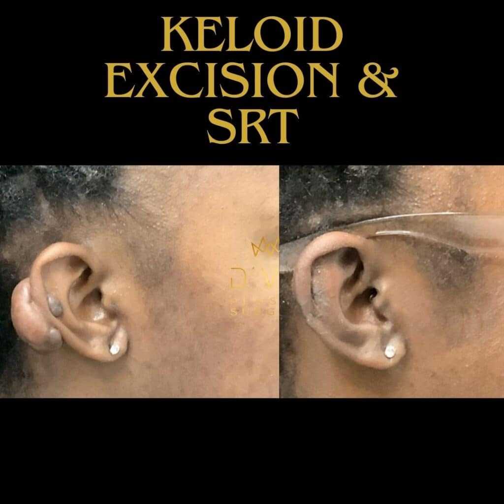 112669 Keloid Excision, SRT