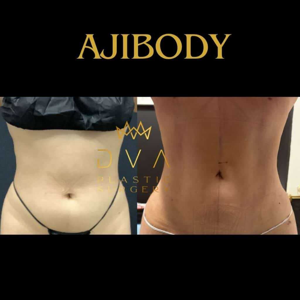 112669 Lipo 360 w Renuvion