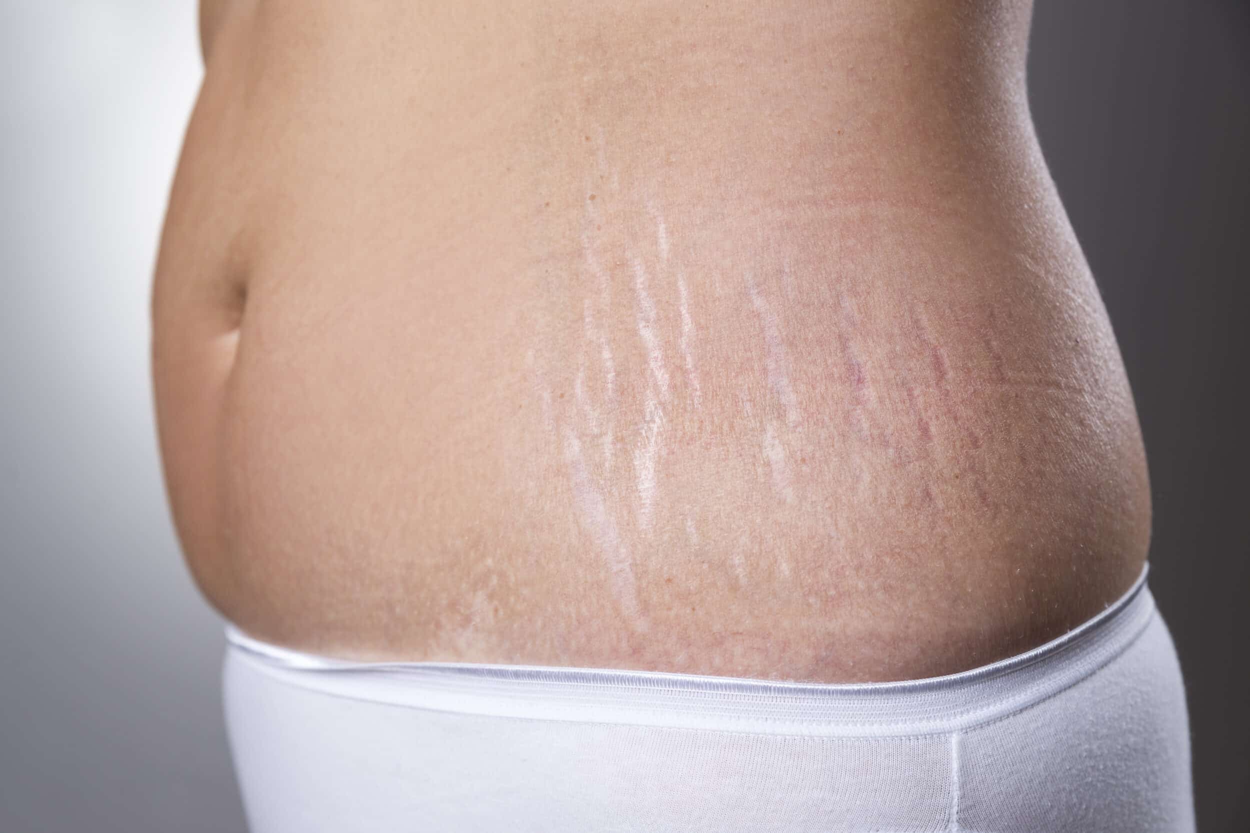 Close up of a woman's stretch marks on her torso after childbirth, in need of a mommy makeover