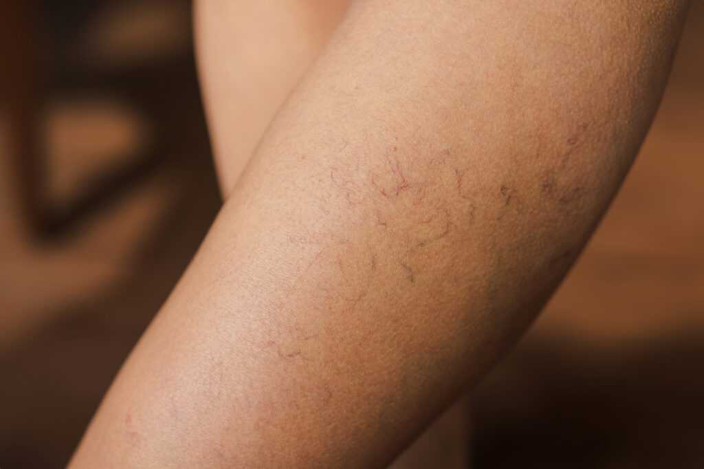 Spider Veins Spider veins on skin